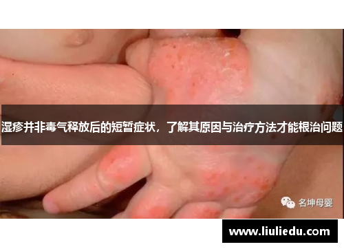 湿疹并非毒气释放后的短暂症状，了解其原因与治疗方法才能根治问题
